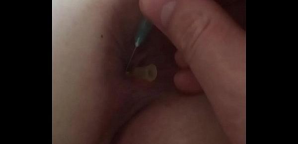  Anal injections female